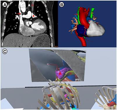 Case report: Thoracoscopic ablation for a patient with atrial fibrillation and persistent left superior vena cava